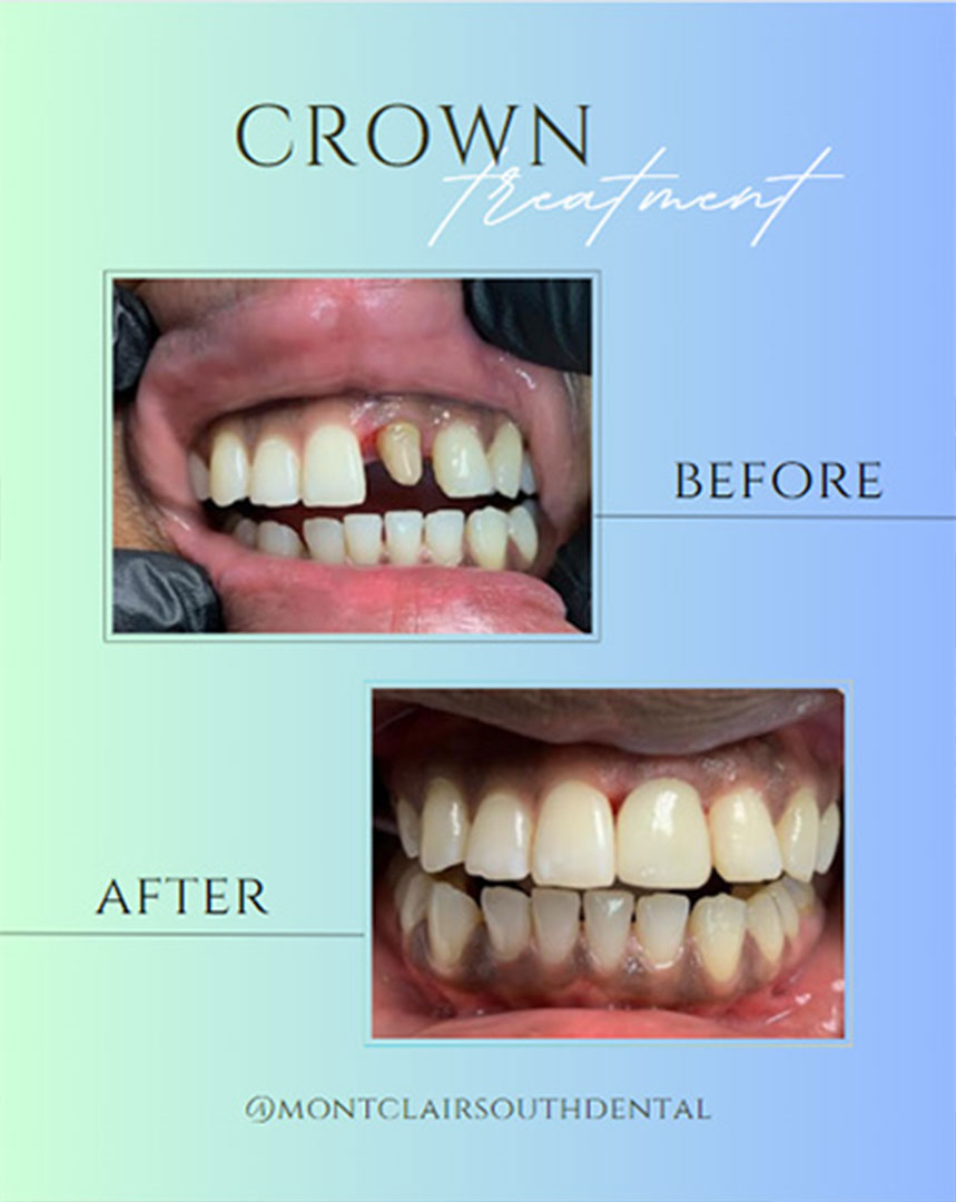 Montclair South Dental | Extractions, TMJ Disorders and Dental Sealants